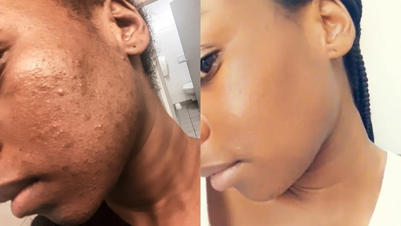 Bouton soudain : La routine simple qui le fait dégonfler en une nuit sans agresser la peau