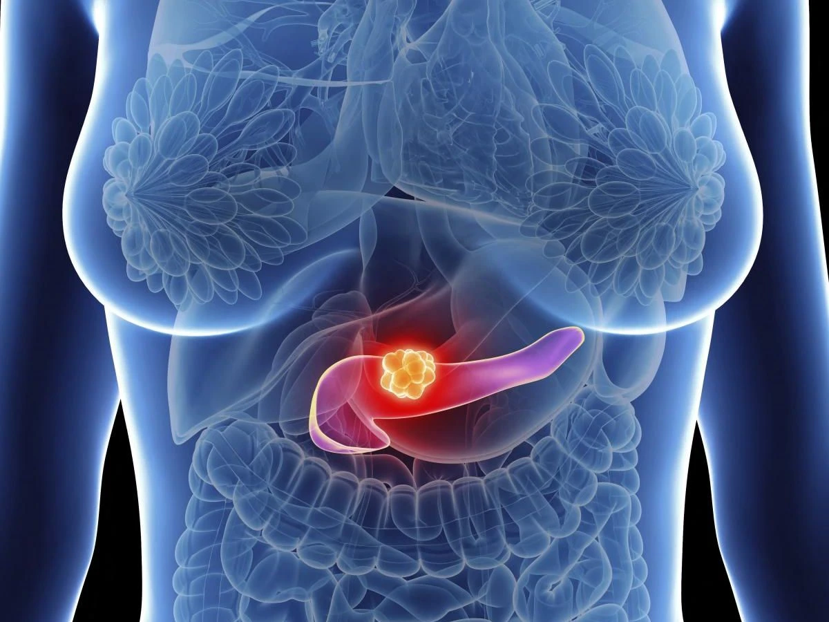 Cancer du pancréas : Un traitement inédit ouvre une nouvelle bataille contre l’un des cancers les plus meurtriers