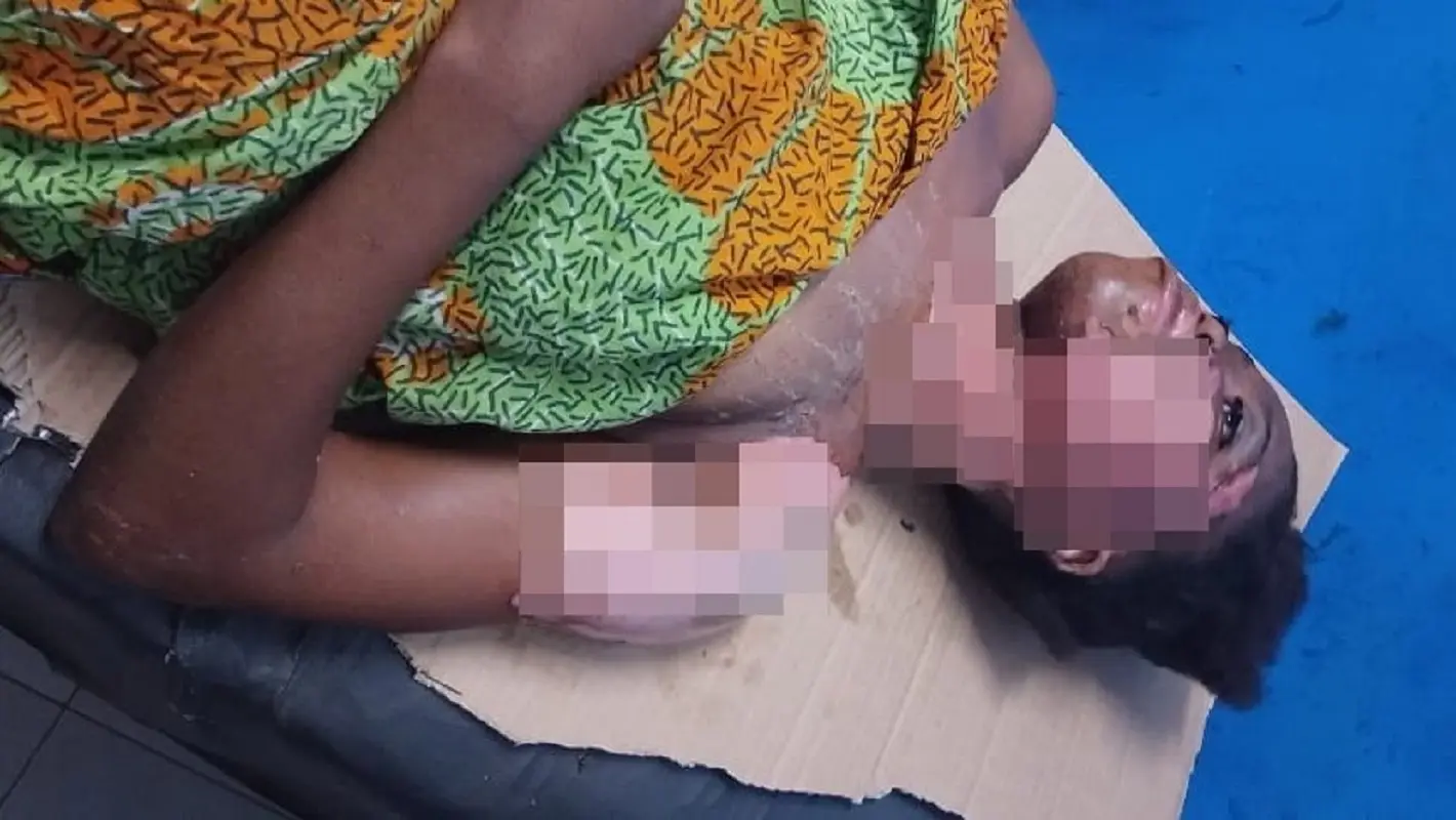 Bangolo : Gravement brûlée à l'essence par son mari à Gaoya, Estelle brise le silence et réclame justice