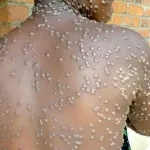 cote-d-ivoire-l-evolution-de-la-variole-du-singe-prend-des-proportions-inquietantes-voici-comment-se-proteger