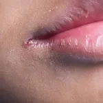 perleche-4-remedes-naturels-efficaces-pour-soulager-et-prevenir-cette-affection