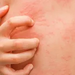 eliminer-la-gale-naturellement-03-astuces-avec-l-huile-essentielle-de-clou-de-girofle