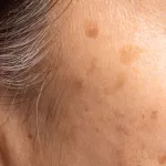 adieu-aux-taches-brunes-4-solutions-naturelles-pour-un-teint-uniforme