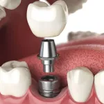 souriez-a-l-avenir-guide-complet-sur-les-protheses-et-implants-dentaires