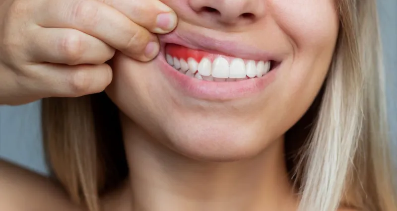 gencives-qui-saignent-trois-bains-de-bouche-efficaces-pour-soulager-et-guerir