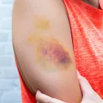 bleus-sur-le-corps-5-remedes-efficaces-et-rapides-pour-soulager-rapidement