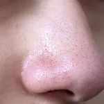 points-noirs-sur-le-nez-5-remedes-naturels-pour-vous-offrir-une-peau-un-teint-parfait