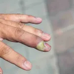 panaris-au-doigt-4-remedes-de-grand-mere-pour-le-soigner-naturellement