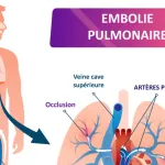 tout-savoir-sur-l-embolie-pulmonaire-une-pathologie-grave-qui-peut-survenir-soudainement