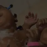 cote-d-ivoire-deux-soeurs-siamoises-separees-avec-succes-a-bingerville