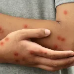 chine-alerte-autour-d-un-nouveau-variant-du-virus-mpox-un-foyer-detecte-chez-un-voyageur