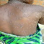 variole-du-singe-en-rdc-pres-de-900-cas-suspects-en-une-semaine
