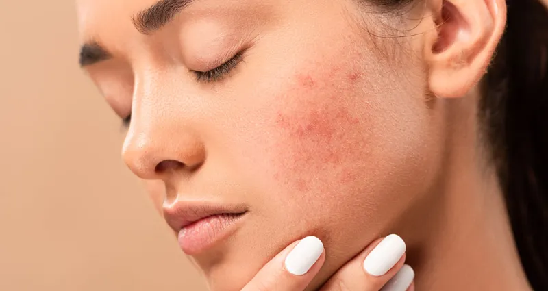 adieu-les-irritations-3-soins-naturels-pour-apaiser-votre-peau-sensible