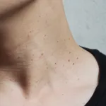 acrochordons-disgracieux-voici-les-remedes-naturels-pour-les-eliminer-en-douceur