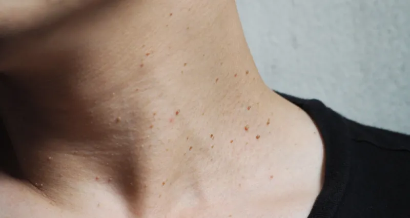 acrochordons-disgracieux-voici-les-remedes-naturels-pour-les-eliminer-en-douceur