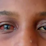 conjonctivite-8-erreurs-qui-ralentissent-la-guerison-de-vos-yeux