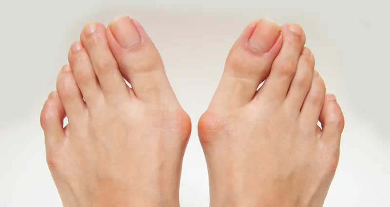 hallux-valgus-7-gestes-simples-pour-eviter-l-operation-et-stopper-la-douleur