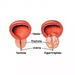 cancer-de-la-prostate-le-risque-de-recidive-est-deux-fois-plus-grand-chez-les-fumeurs