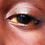 traitement-de-la-conjonctivite-appolo-l-utilisation-des-medicaments-traditionnels-deconseillee