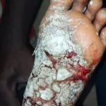 gagnoa-une-dame-brule-les-pieds-de-sa-niece-de-6-ans-pour-l-empecher-de-sortir