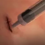 une-colle-chirurgicale-pour-refermer-les-plaies-en-une-minute