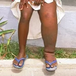 journee-mondiale-des-maladies-rares-l-elephantiasis-une-maladie-qui-gagne-du-terrain-en-cote-d-ivoire