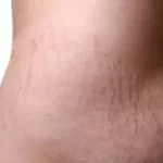 estompez-vos-vergetures-en-un-mois-grace-a-cette-astuce