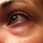 cinq-astuces-naturelles-contre-les-cernes