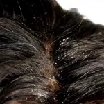 cinq-remedes-efficaces-contre-les-pellicules