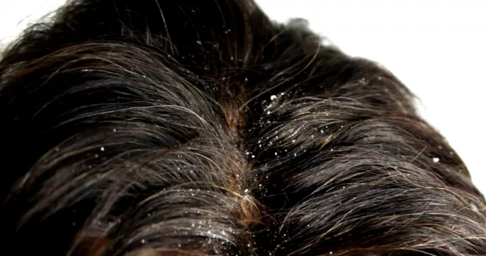 cinq-remedes-efficaces-contre-les-pellicules