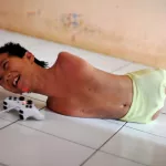 france-des-enfants-sans-bras-voient-le-jour