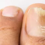 mycose-des-ongles-voici-comment-y-remedier