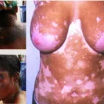 interdiction-des-produits-eclaircissants-pourquoi-la-cote-d-ivoire-doit-suivre-l-exemple-du-rwanda