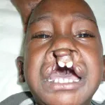 quand-des-malades-deformes-et-desesperes-retrouvent-le-sourire-repares-par-l-ong-sourire-un-jour-plus-d-une-centaine-de-cas-pris-en-charge