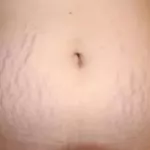 comment-se-debarrasser-des-vergetures-naturellement-et-rapidement