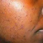 comment-en-finir-avec-les-acnes-ma-recette-miel-et-citron