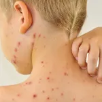 astuces-naturelles-pour-faire-disparaitre-les-cicatrices-de-la-varicelle