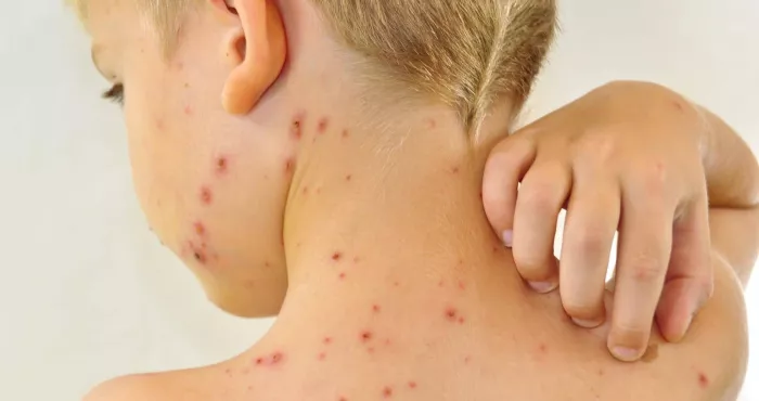 astuces-naturelles-pour-faire-disparaitre-les-cicatrices-de-la-varicelle