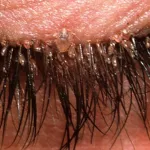 les-faux-cils-un-danger-pour-les-yeux-les-medecins-alertent-sur-cette-technique-de-beaute-qui-favorise-l-apparition-de-poux