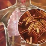 sud-comoe-565-cas-de-tuberculose-recenses