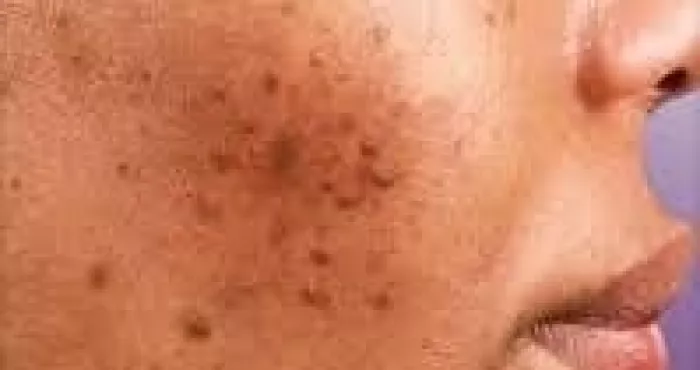 comment-chasser-les-petits-boutons-du-visage-naturellement