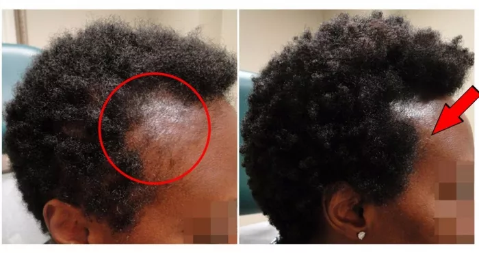 astuces-pour-lutter-contre-la-chute-des-cheveux