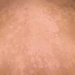 astuces-pour-soigner-les-dartres-naturellement