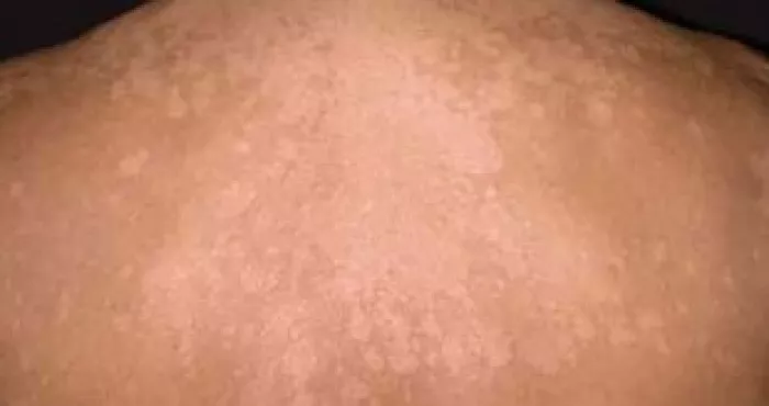 astuces-pour-soigner-les-dartres-naturellement