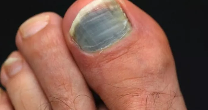 mycose-des-ongles-un-remede-pour-en-finir-avec-cette-maladie