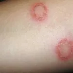 comment-soigner-la-teigne