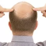 coronavirus-les-hommes-chauves-seraient-les-plus-vulnerables