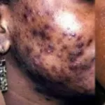 depigmentation-des-pratiques-et-produits-qui-mettent-en-danger-voici-les-maladies-de-la-peau-les-plus-frequentes