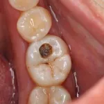 comment-prevenir-la-carie-dentaire-les-aliments-a-eviter