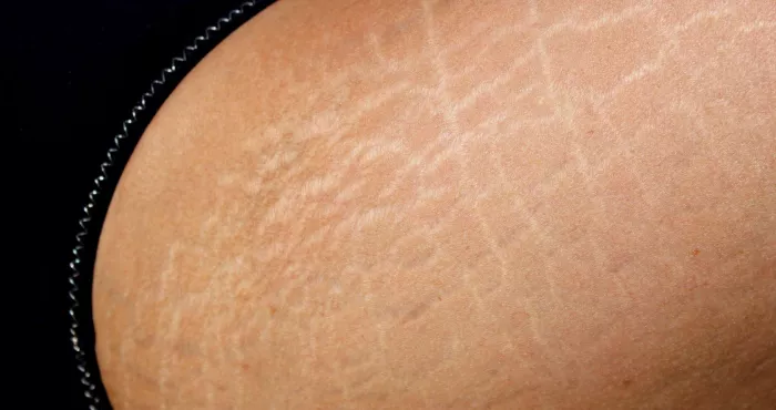 astuces-beaute-ce-qu-il-faut-savoir-pour-se-debarrasser-des-vergetures